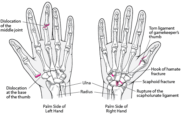 Hand Fractures - Injuries and Poisoning - Merck Manual Consumer Version