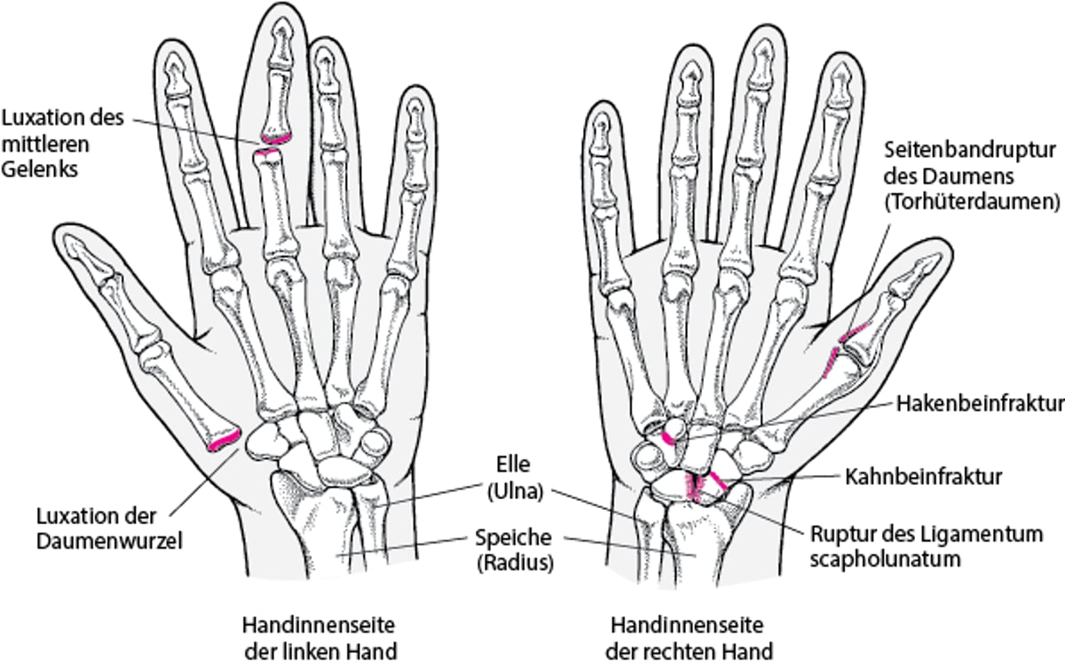 Häufige Handverletzungen