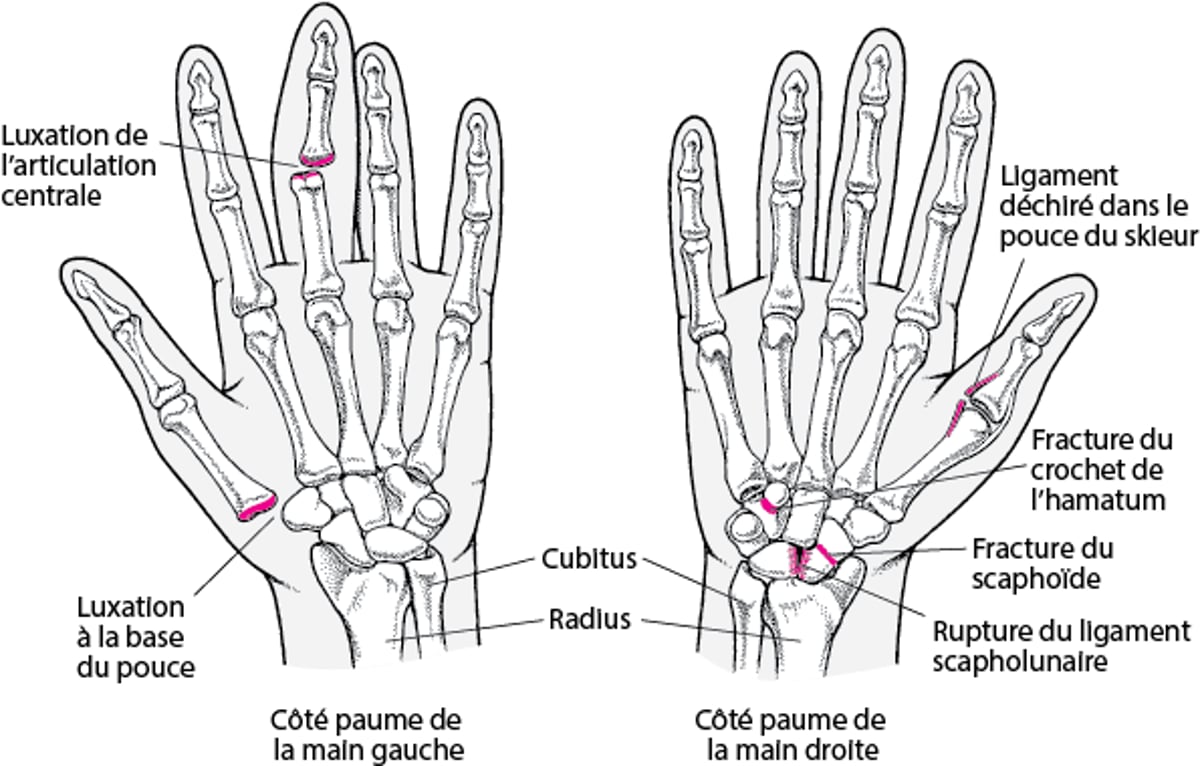 Traumatismes fréquents de la main