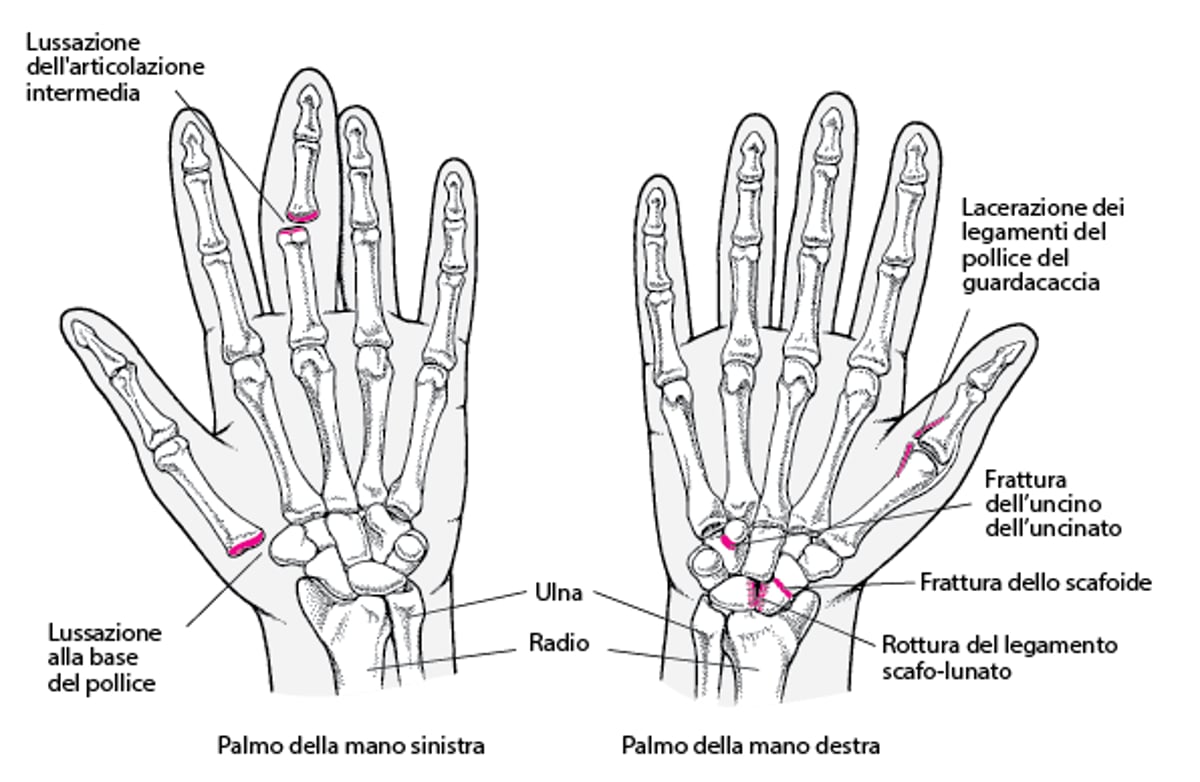 Traumi comuni della mano