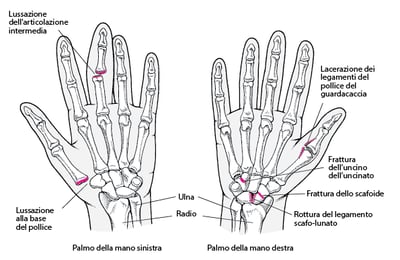 Traumi comuni della mano