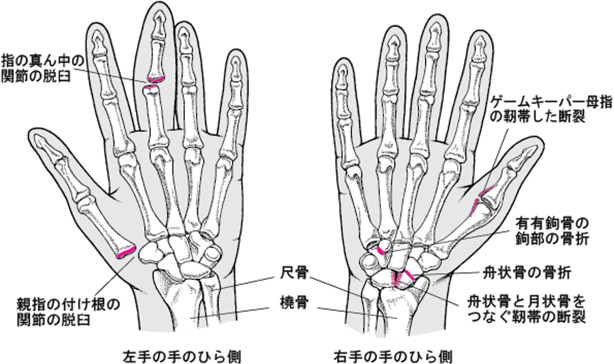 一般的な手のけが