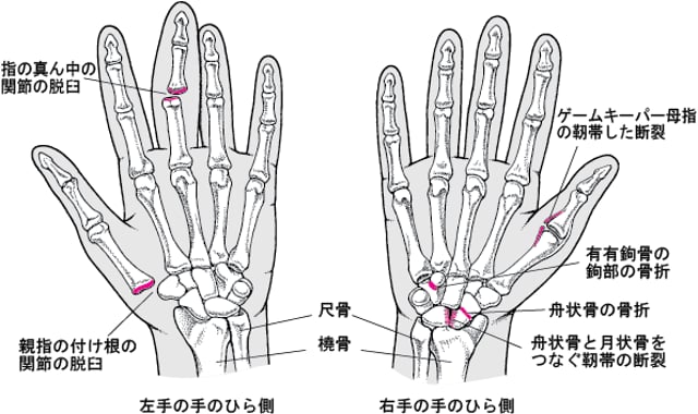 手の骨折 - 25. 外傷と中毒 - MSDマニュアル家庭版