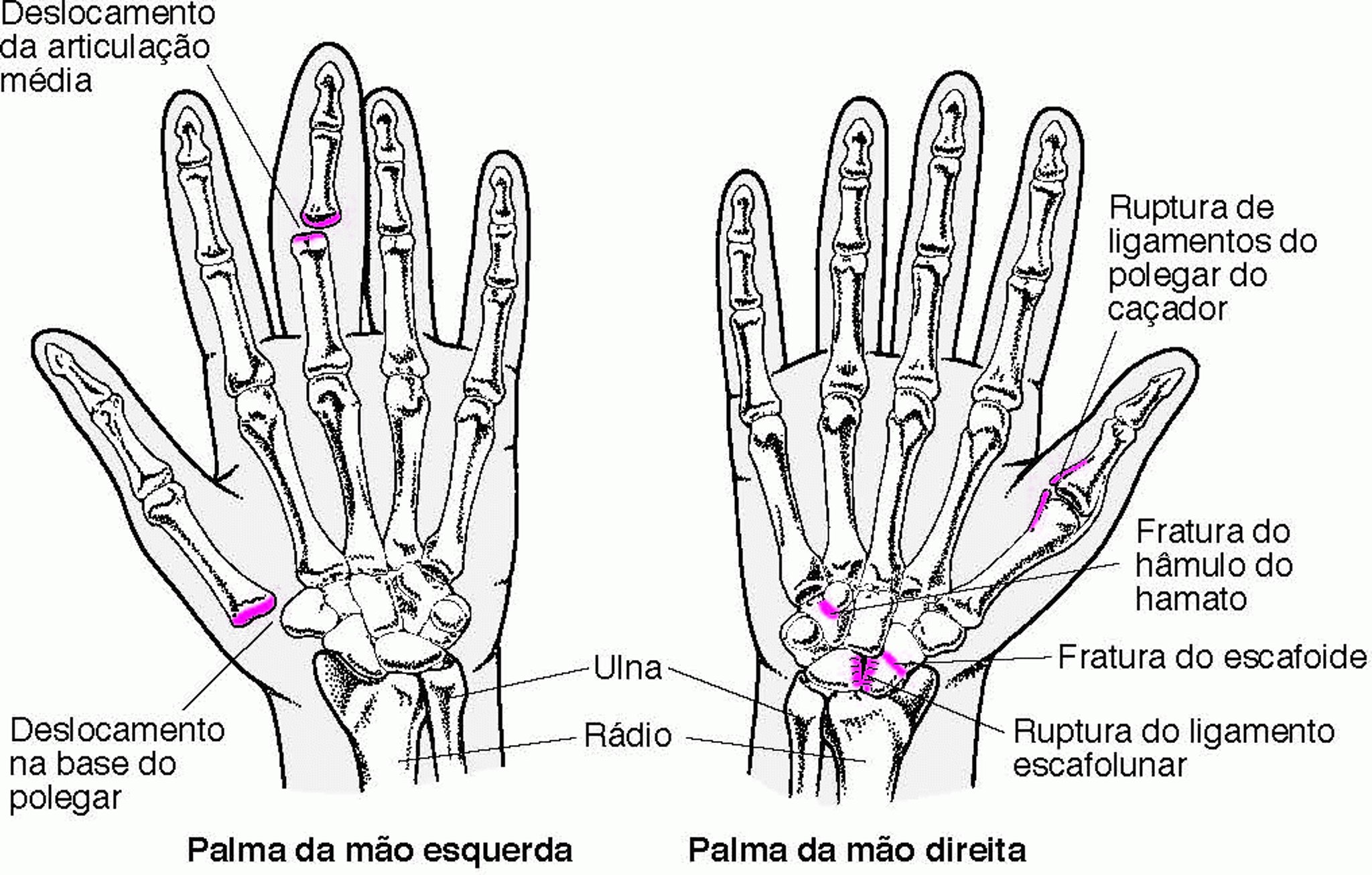 Lesões comuns nas mãos