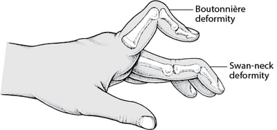 When the Fingers Are Abnormally Bent