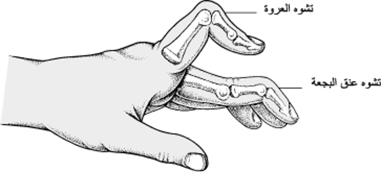عندما تكون الأصابع منحنية بشكلٍ غير طبيعي