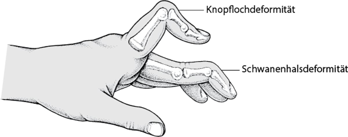 Auffällige Krümmung der Finger