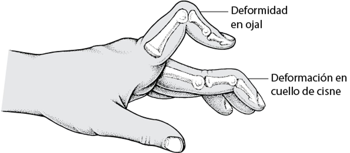 Doblamiento anómalo de los dedos