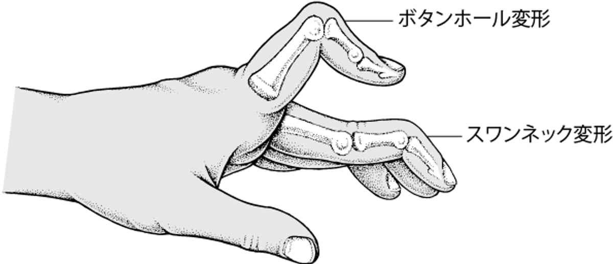 手の指の変形