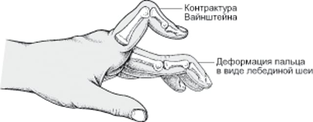 Состояния, которые сопровождаются патологической деформацией пальцев