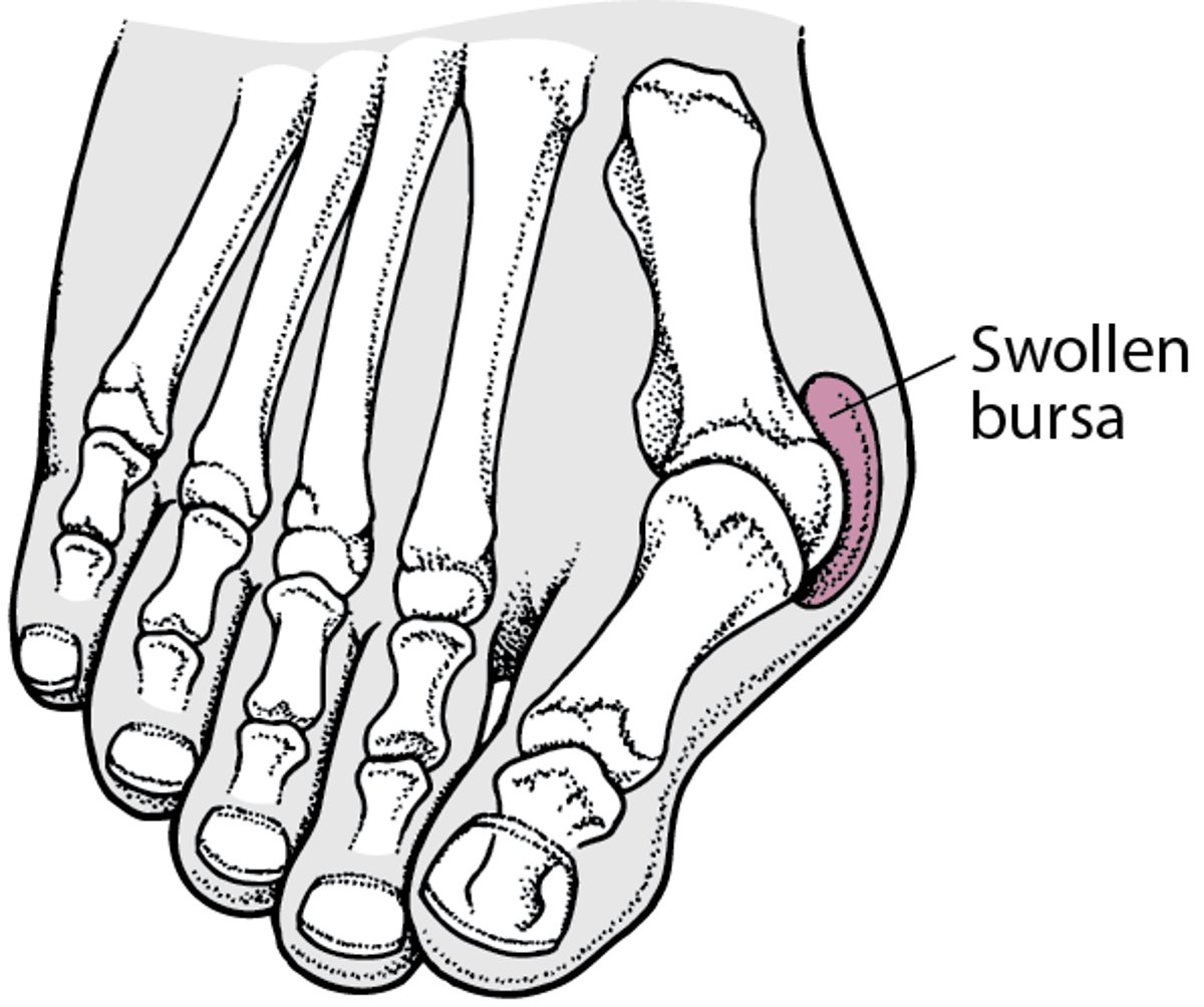 Hallux Valgus With a Bunion