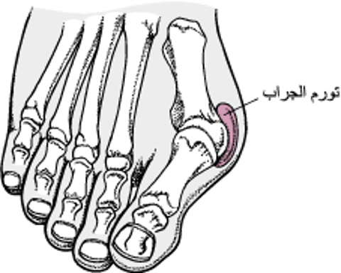 إِبهامُ القَدَمِ الأَروَح مع الوكعة