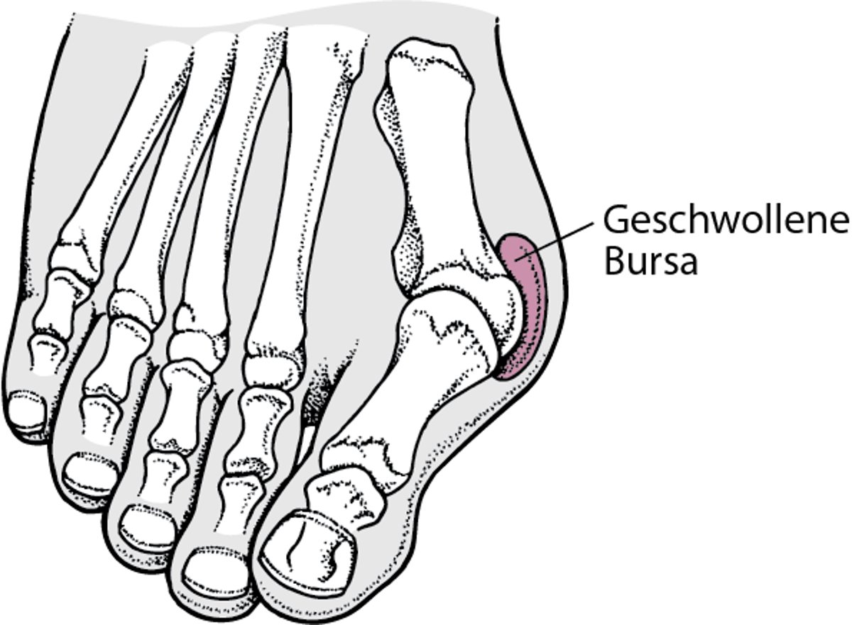 Hallux valgus mit Ballenzeh