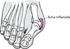 Hallux valgus con un juanete