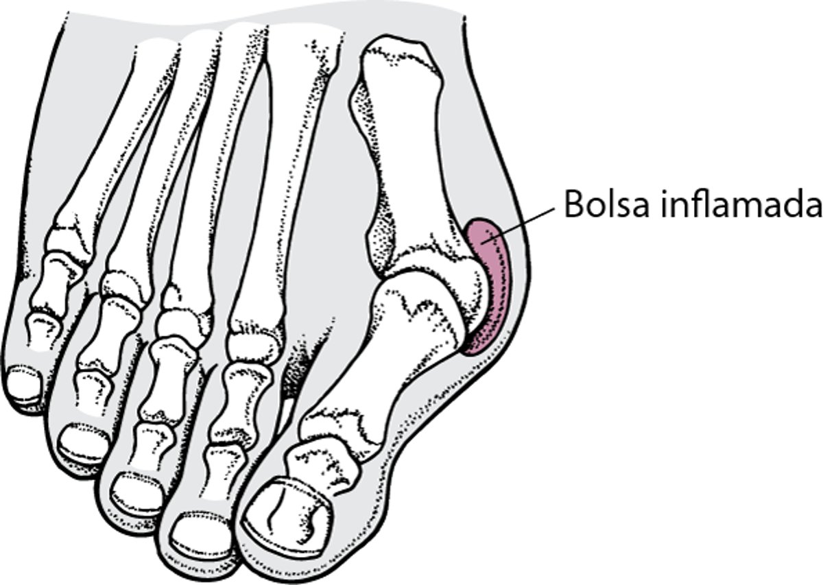 Hallux valgus con un juanete