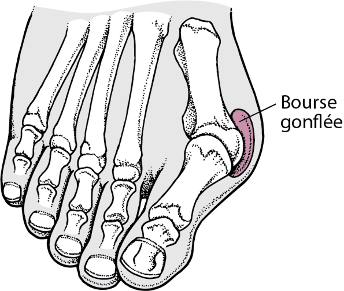 Hallux valgus avec un oignon