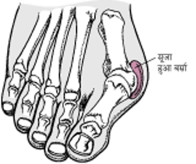 बुनियन के साथ हेलक्स वैल्गस