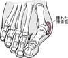 バニオンを伴った外反母趾