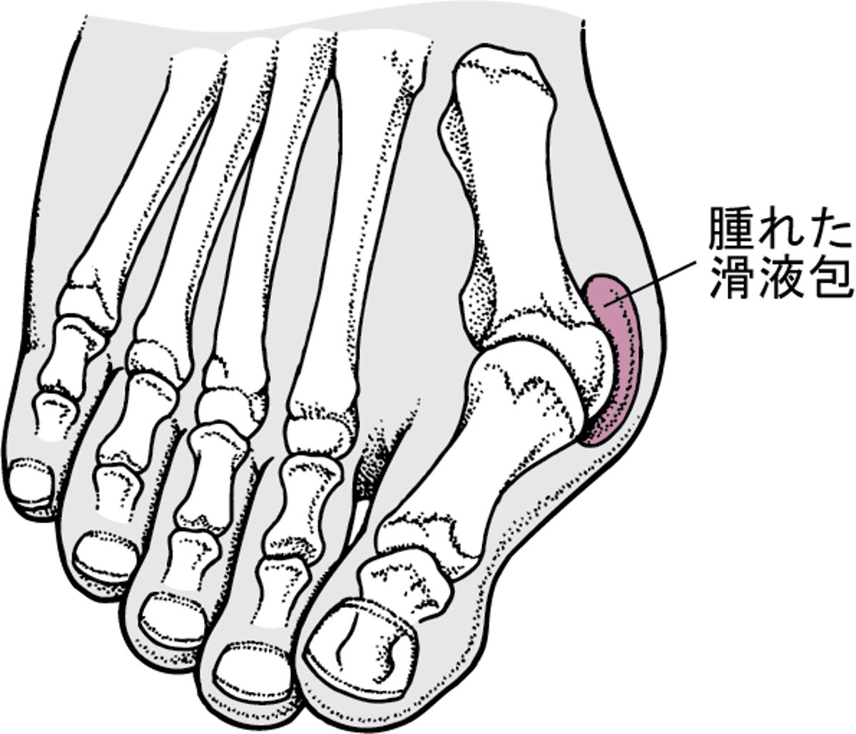 バニオンを伴った外反母趾