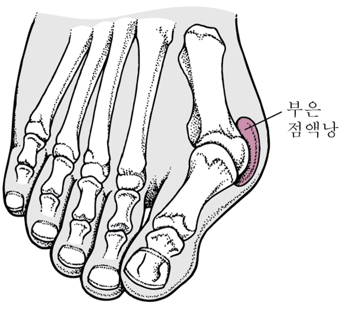 건막류를 동반한 외반무지