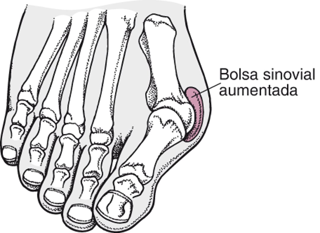 Hallux Valgus com um joanete