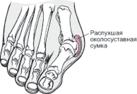 Вальгусная деформация большого пальца стопы и шишки в области первого плюсне-фалангового сустава