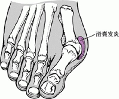 拇趾外翻与拇囊炎
