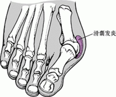 Image:拇趾外翻与拇囊炎-《默沙东诊疗手册大众版》