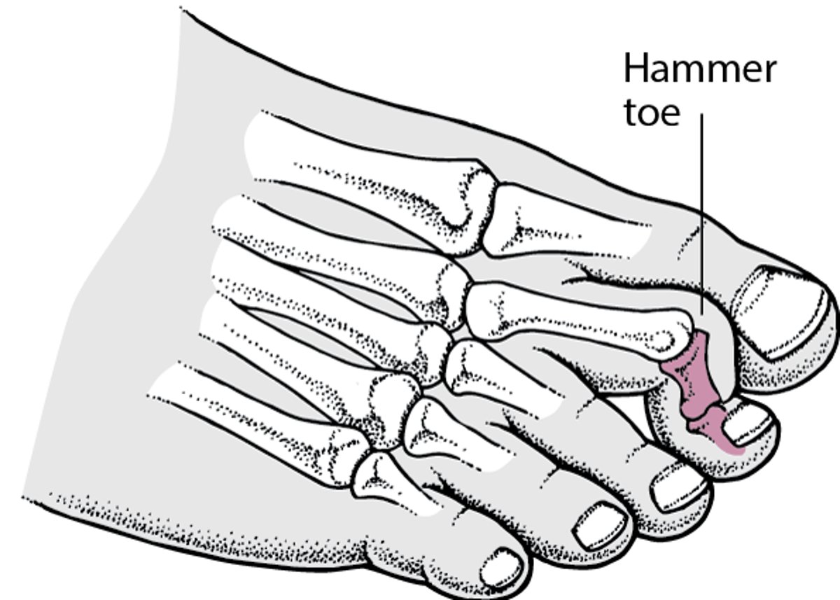 Hammer Toe