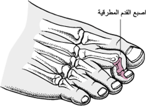 إصبع القدم المطرقيَّة