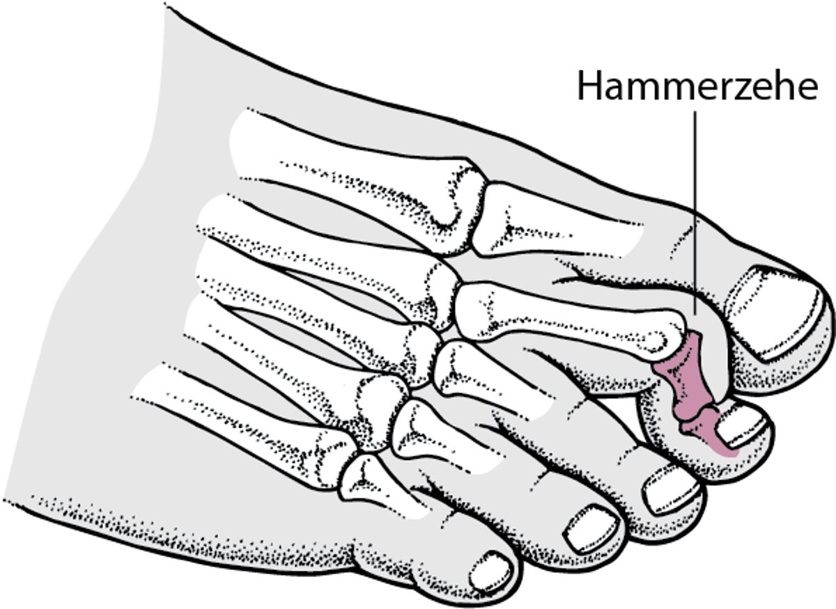 Hammerzehe