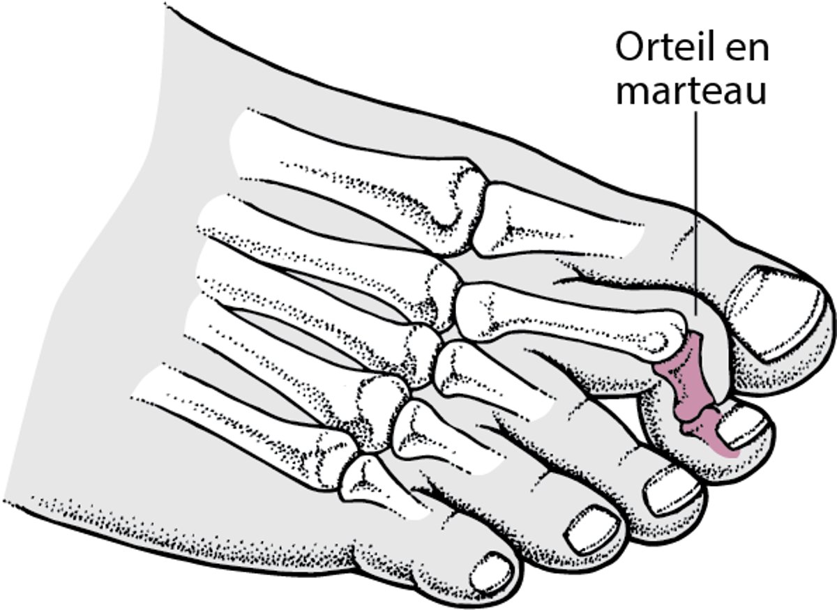 Orteil en marteau