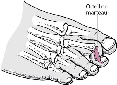 Orteil en marteau