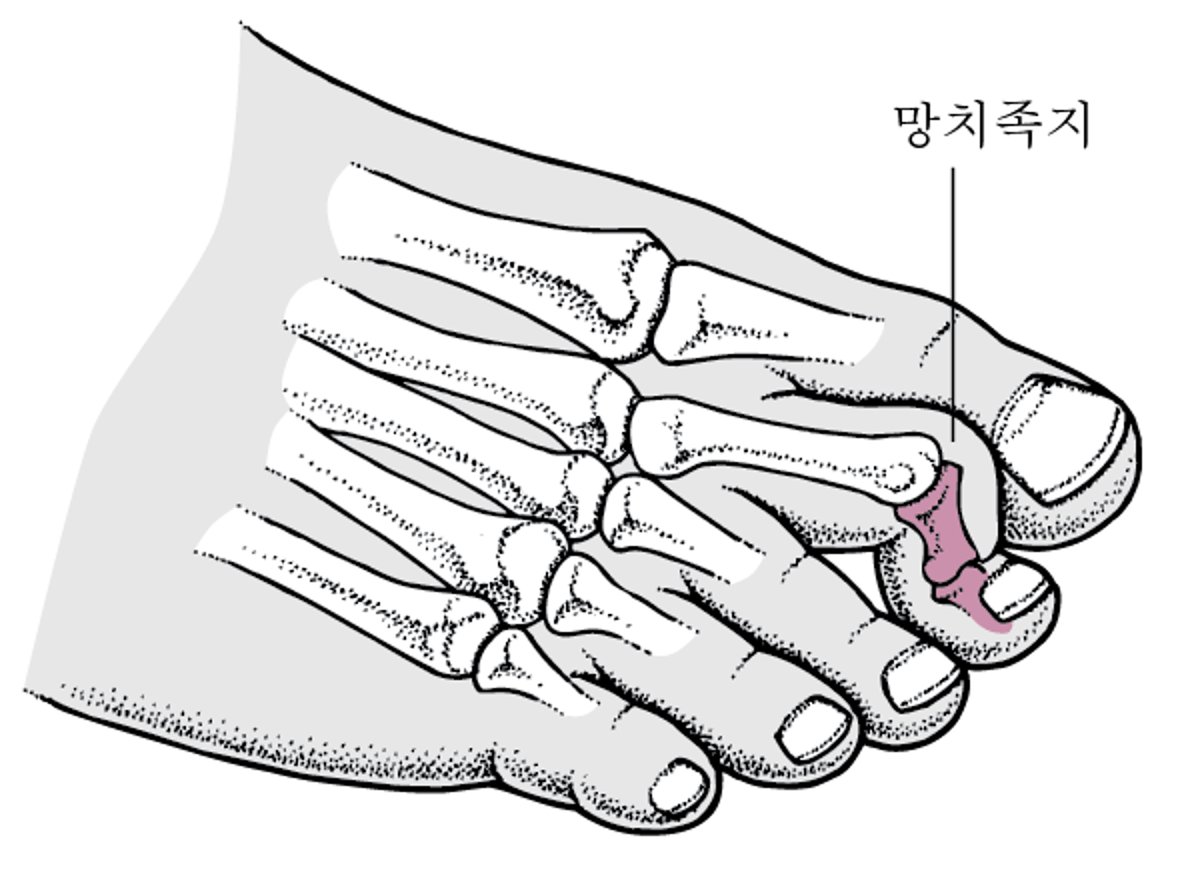 망치 발가락