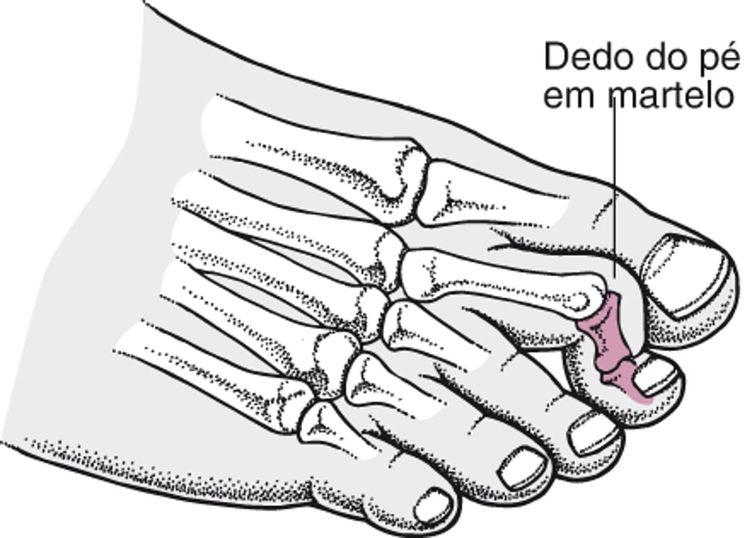 Dedo do pé em martelo