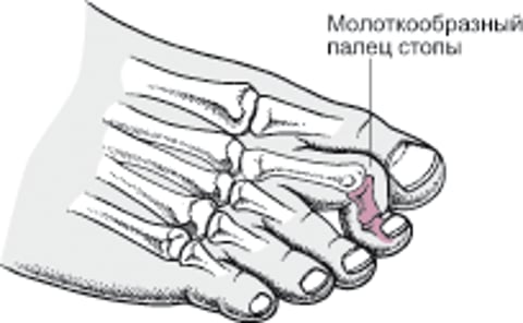 Молоткообразный палец стопы