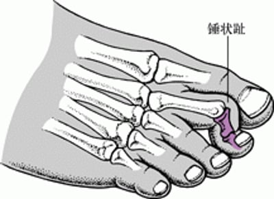锤状趾