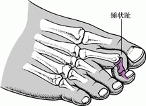 锤状趾