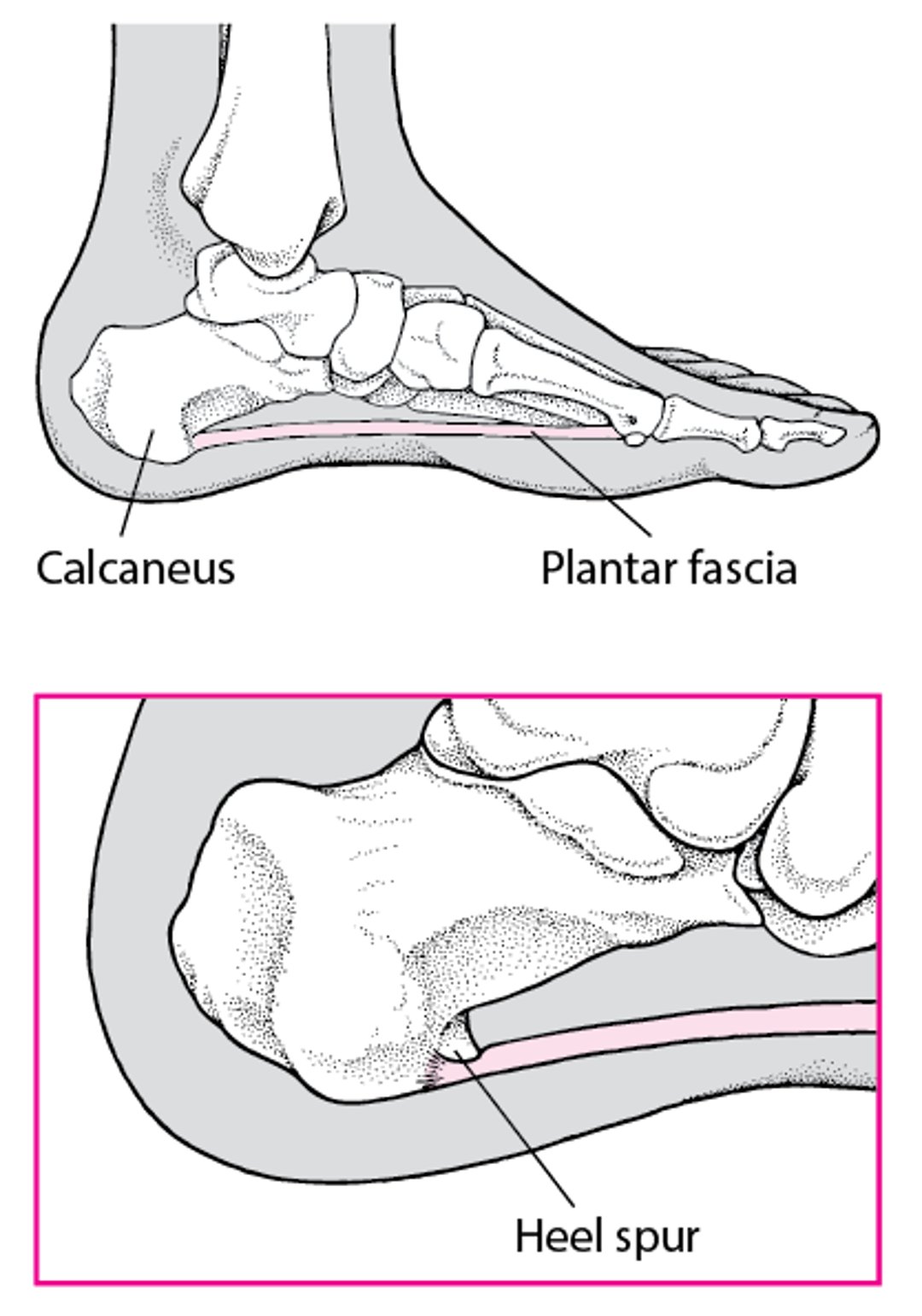 What Is a Heel Spur?