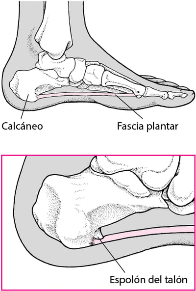 ¿Qué es el espolón del talón?