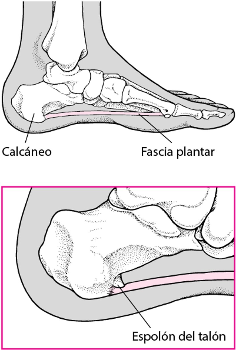 ¿Qué es el espolón del talón?