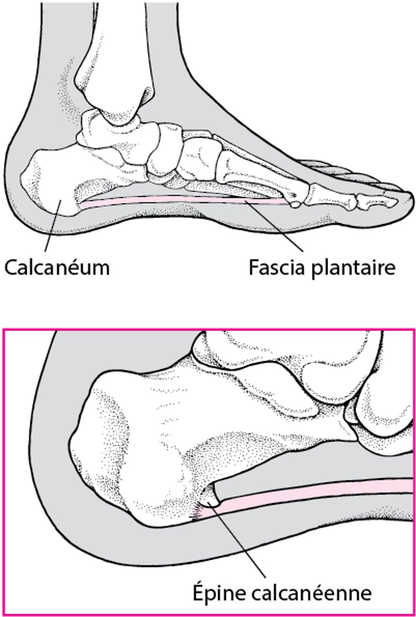 Qu’est-ce qu’une épine calcanéenne ?