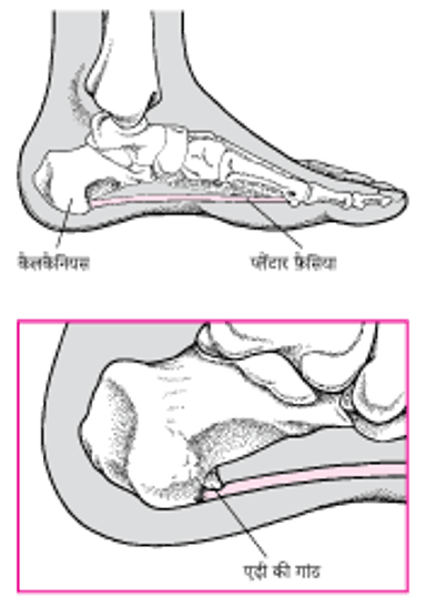 एड़ी की कील क्या होती है?