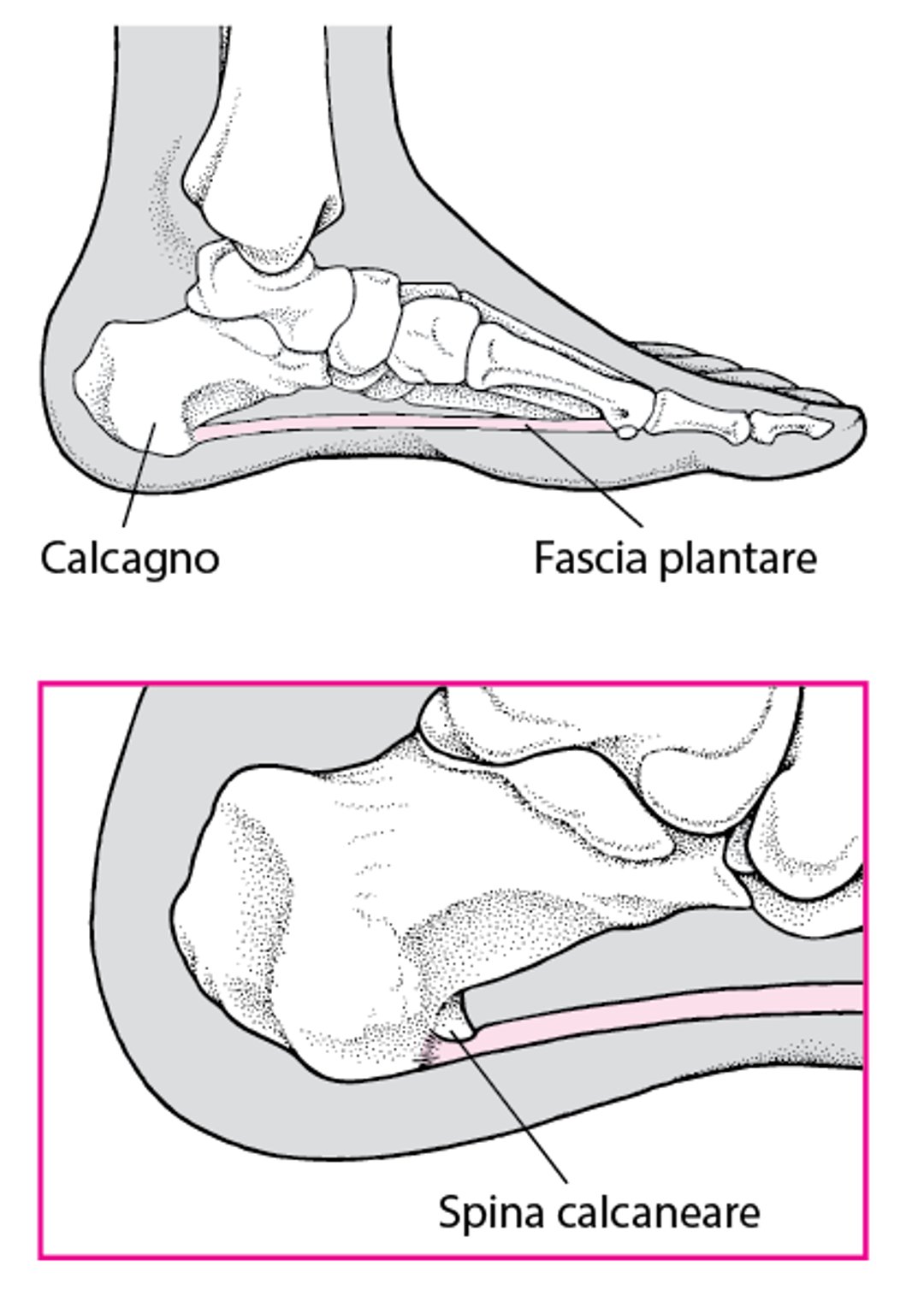 Che cos’è una spina calcaneare?
