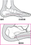 踵骨棘とは