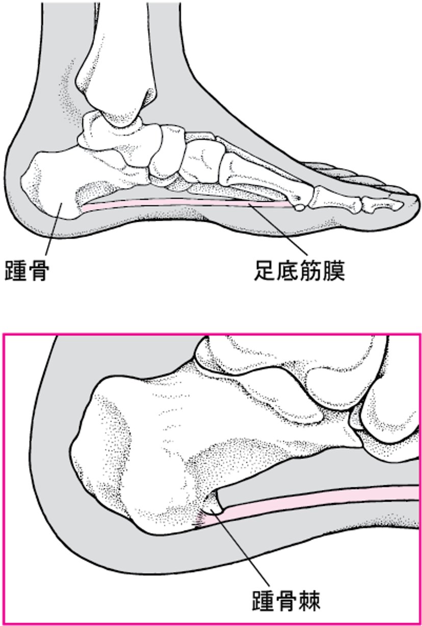 踵骨棘とは