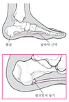 발뒤꿈치 돌기란 무엇입니까?