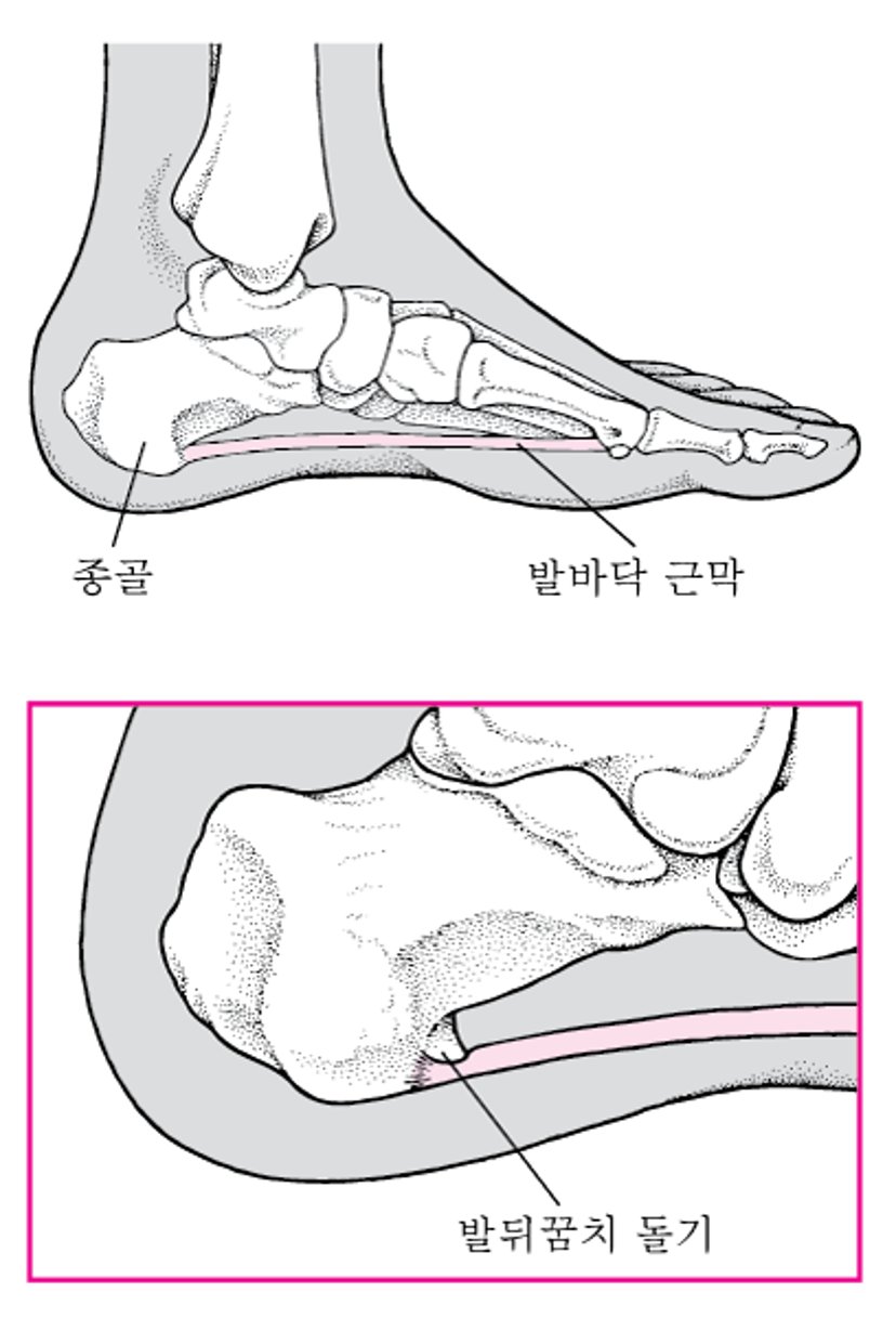 발뒤꿈치 돌기란 무엇입니까?