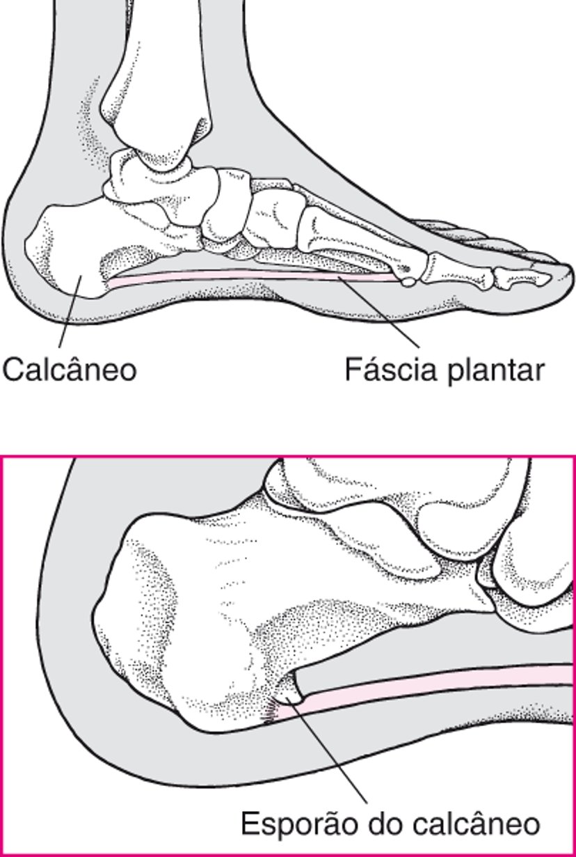 O que é esporão do calcâneo?