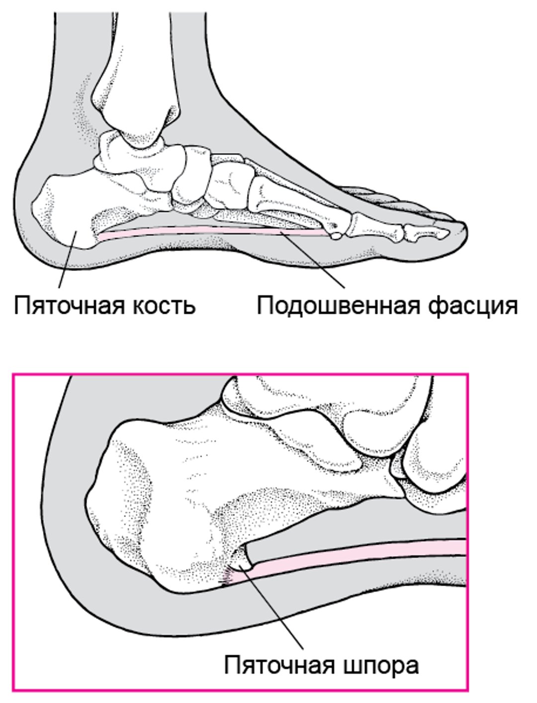 Что такое пяточная шпора?